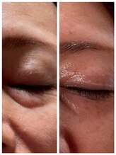 マーレン(Malen)/レッドショット症例写真