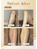 【夏が来る前に★】メンズ脱毛 肘下 or 膝下 ¥4400