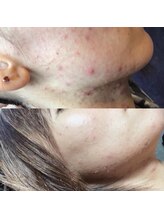 ビンナ 五反田店(Binna)/ハーブピーリング