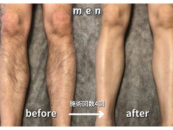 キュー(cue)/【メンズ】「脚脱毛」施術事例