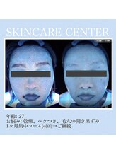 アンジェラックス スキンケアセンター心斎橋/27歳　皮脂詰まりケア