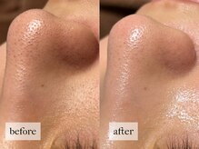 ヒナノ 矢場町店(HINANO)/ハーブピーリング