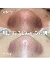 フレル(FUREL)/お肌の変化に驚愕！