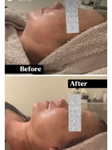 カエラ(KAELA)/レモンボトル3回目