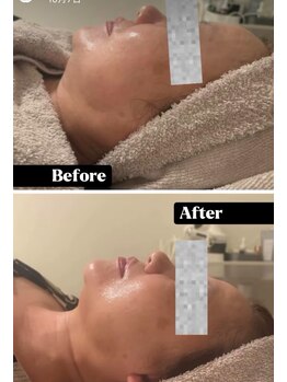 カエラ(KAELA)/レモンボトル3回目