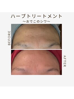 ツヤハダコガオ 千葉店/before⇒afterハーブピーリング