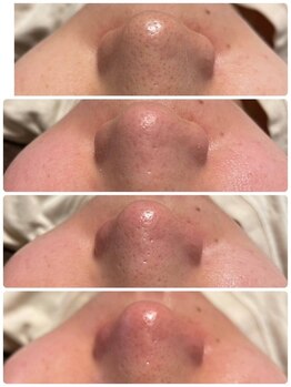 ユフラ(Juhla)/韓国式3D毛穴洗浄