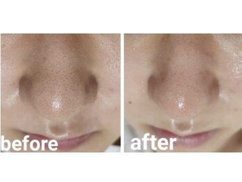 カヌヌ(kanunu)/毛穴洗浄/ハーブピーリング