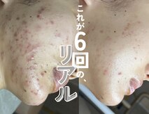 ソアスキン(SOAskin)