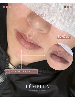 エルビービュティーサロン(LB BEAUTY SALON)/【ルメラ乳輪】実績数関西1★