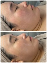リノ(Lino)/小顔コルギ一回の変化