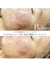 エスプリ 銀座店/ハーブピーリング銀座