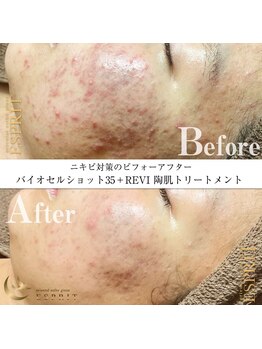 エスプリ 銀座店/ハーブピーリング銀座