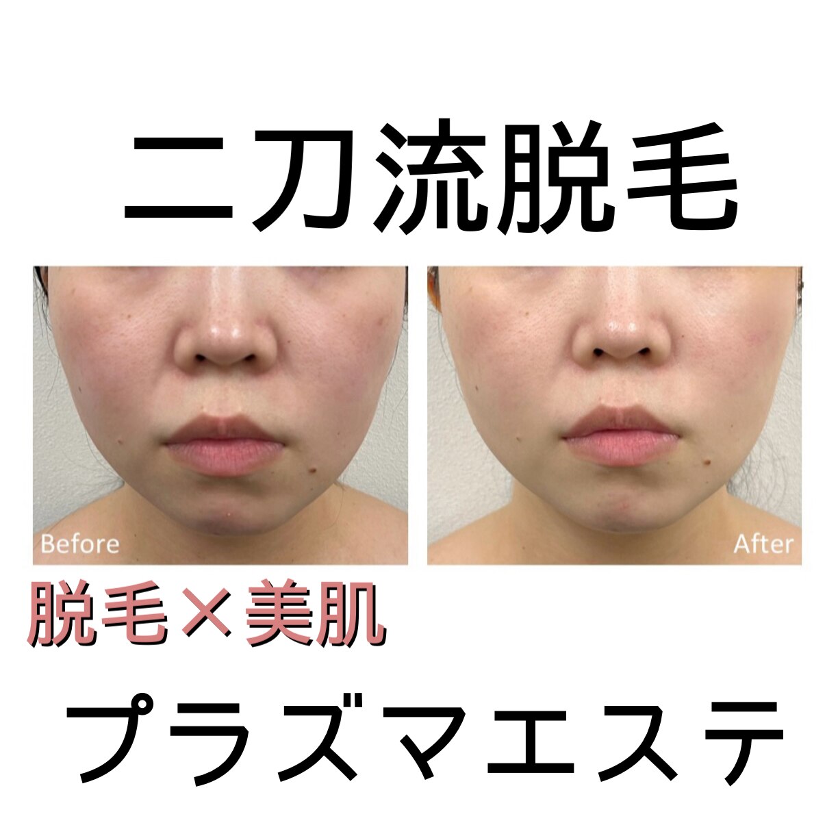 鈴鹿市で毛穴洗浄・毛穴吸引が人気のエステサロン｜ホットペッパー