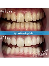 ホワイトニングカフェ 綾瀬店(WhiteningCafe)/◎歯のホワイトニング施術写真◎