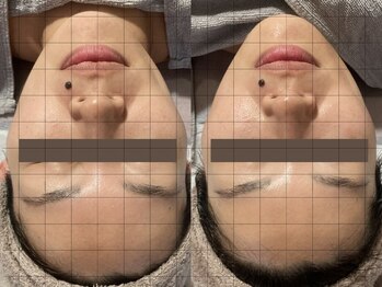 シェリー(CHERIE)/リフトアップコース