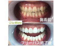 ルブラン 奈良店(Le Blanc)/歯の黄ばみ諦めないで下さい！