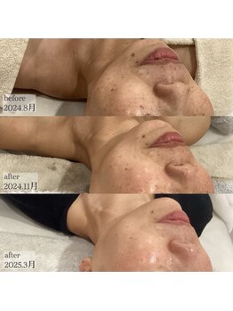 ランタン(Lantern)/幹細胞ハーブトリートメント