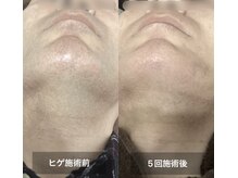 リリー(RILY)の雰囲気（1番人気のヒゲ脱毛♪髭剃り不要に最短で導きます!メンズ脱毛/VIO）