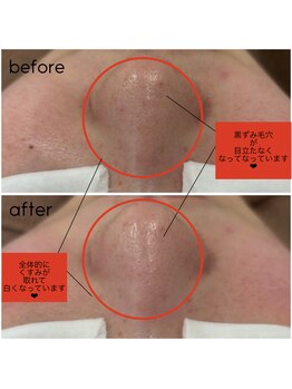 ポアレスラボ 東武百貨店池袋店/トリートメント1回での効果