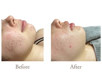 アダム(Adam)/ハーブピーリングによる肌質変化