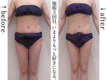 全身筋膜痩身―ビフォーアフター