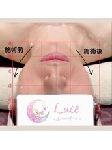 ルーチェ(Luce)/【レディース】フェイシャル比較