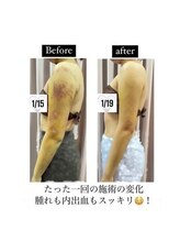 インディバケアプラチナム 横浜店/インディバ施術