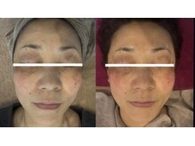 ジュエルオーキッド(Jewel orchids)/ハーブ×シミケア×プラズマ