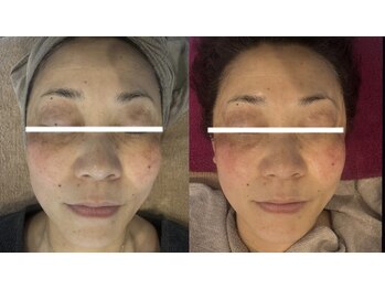 ジュエルオーキッド(Jewel orchids)/ハーブ×シミケア×プラズマ