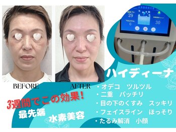 ヨサパーク ジュエル ハビビ 水木店(YOSA PARK JEWEL HABIBI)の写真/水素・ハーブで毛穴に詰まった頑固な汚れと角質をごっそり除去！シワやたるみを改善し透き通った美肌へ！