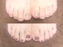 グラシナ なんば店/深爪/自爪育成/フィルイン
