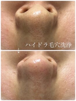 セムヤネイル(sem'ya nail)/ハイドラ毛穴洗浄
