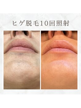 ボゴス(BOGOSS)/ヒゲ脱毛10回照射