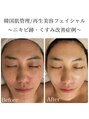 ロイヤル(ROYAL)&nbsp;毛穴、ごわつきが改善されキメが整った潤肌へ◎