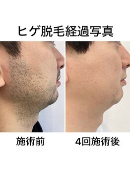 FRONTの写真/【痛みの少ない最新脱毛】気になるひげも都度払いで賢くケア！清潔感溢れるツルスベ肌を叶えます。