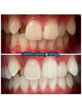 ホワイトニングショップ 鈴鹿店/Before&After美白ホワイトニング