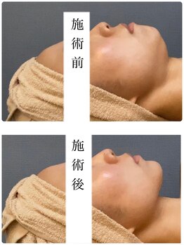 肌音色/■ハイパーフォトケア施術例