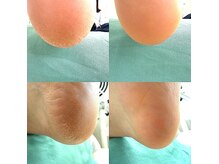 上高田つつじ整体院の雰囲気（フットケアで綺麗な足に 角質/魚の目/かかとのケア 片足 ¥3300）