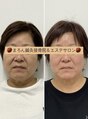 まろん鍼灸接骨院 立川店 美容鍼&小顔矯正コルギ1回目→8回目のBefore After♪