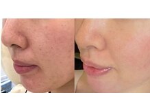 アロール(ALLURE)/グリーンピール