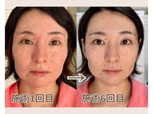 ルビーミー(Ruby's Me)/美顔筋テラボーラー症例