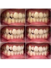 ホワイトニングショップ 静岡店/プレミアムホワイトニング経過！