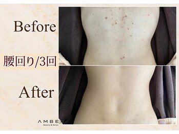 アンバー 恵比寿(AMBER)/ダウンタイム有ハーブピーリング