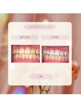 プラスビーセルフ(+b self)/ホワイトニングビフォーアフター