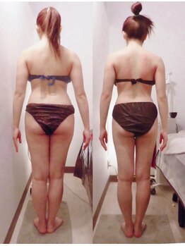 パルティール(PARTIR)/◆痩身　症例写真