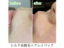 ナチュウル(Natulu)の雰囲気（鼻下の産毛や女性髭も綺麗に♪細かい箇所まで根元から綺麗！）
