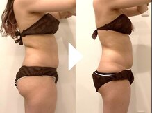 ビースト 下北沢店(B-st.)/痩身｜上半身3回