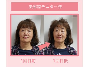グリーンノア鍼灸院/美容鍼を1回受けた変化