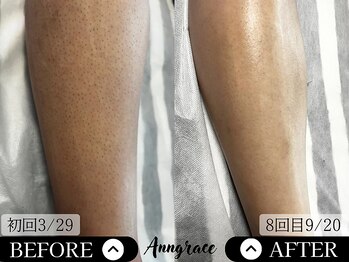 アングレイス(Anngrace)/【全身脱毛脚】Before/After